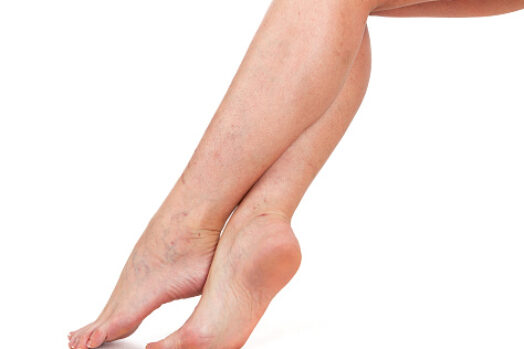 Legs of a woman. Skin with vascular stars. White background